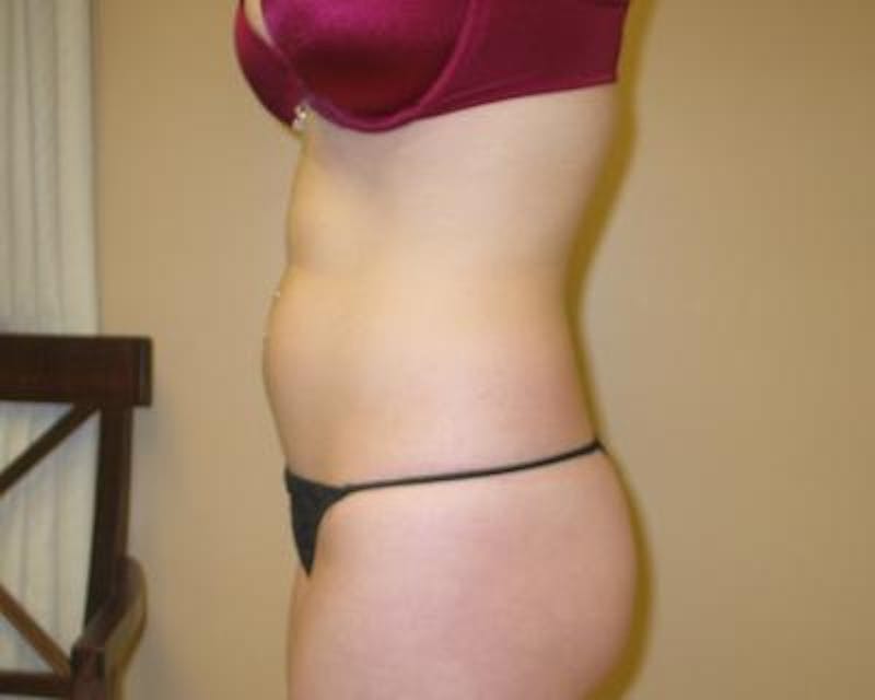 Liposuction Gallery - Patient 120346657 - Image 1