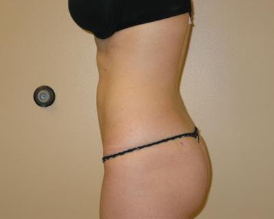Liposuction Before & After Gallery - Patient 120346657 - Image 2