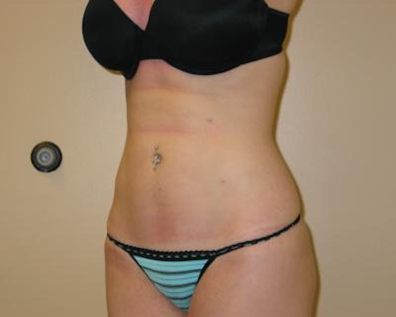 Liposuction Before & After Gallery - Patient 120346657 - Image 4