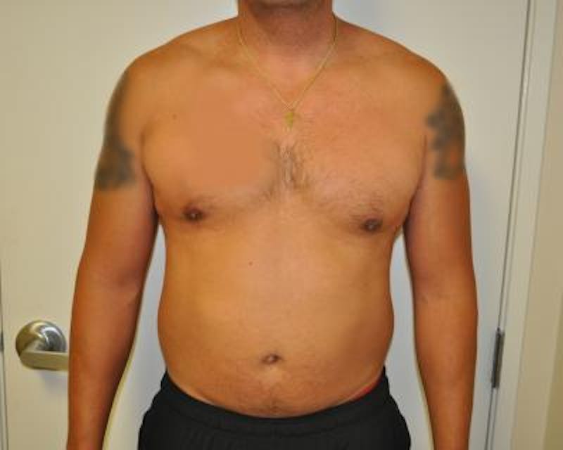 Liposuction Before & After Gallery - Patient 120346660 - Image 1