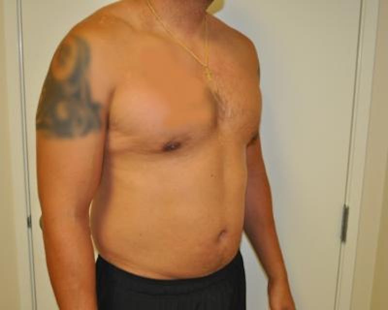Liposuction Before & After Gallery - Patient 120346660 - Image 3