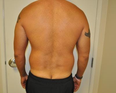 Liposuction Before & After Gallery - Patient 120346663 - Image 1