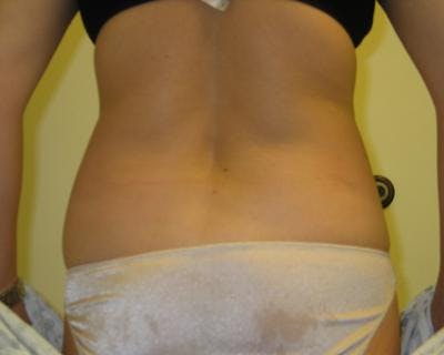Liposuction Gallery - Patient 120346664 - Image 1