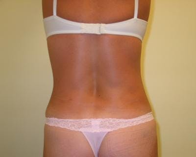 Liposuction Gallery - Patient 120346664 - Image 2