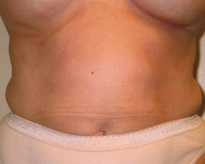 Liposuction Before & After Gallery - Patient 120346666 - Image 1