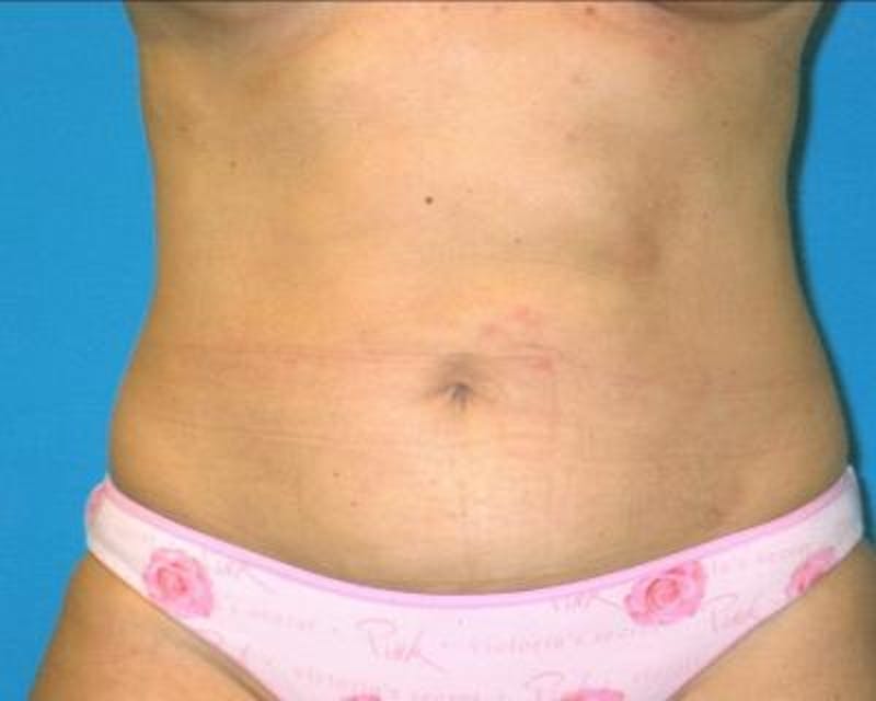 Liposuction Gallery - Patient 120346666 - Image 2