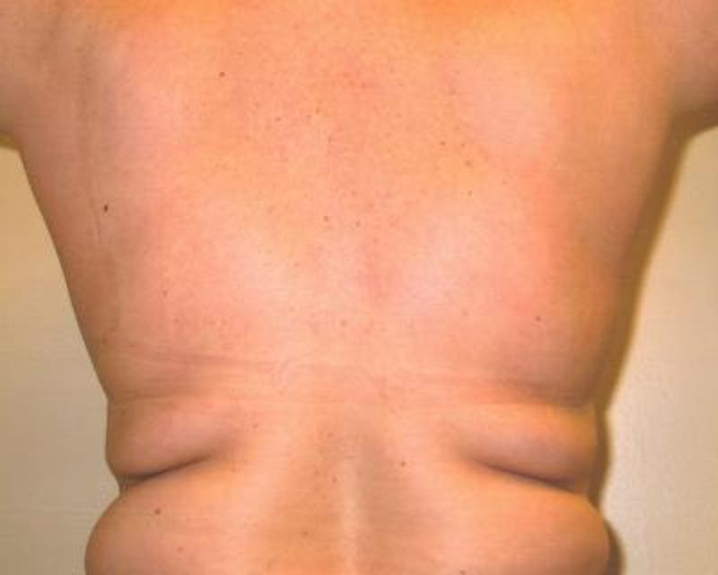 Liposuction Before & After Gallery - Patient 120346666 - Image 3