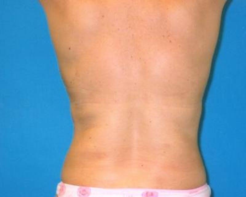 Liposuction Gallery - Patient 120346666 - Image 4