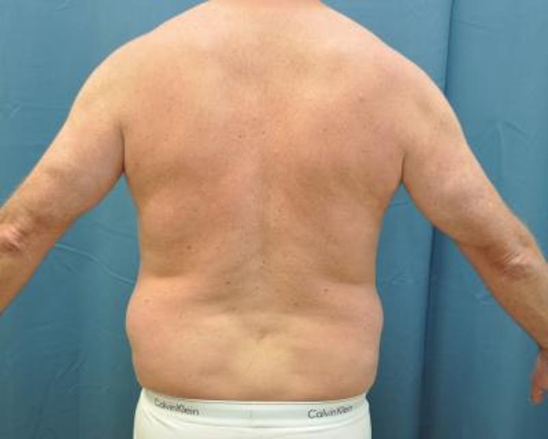 Liposuction Gallery - Patient 120346674 - Image 5