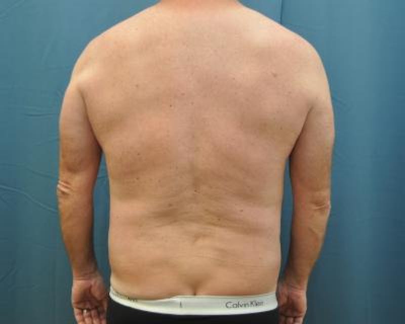 Liposuction Before & After Gallery - Patient 120346674 - Image 6