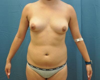 Liposuction Before & After Gallery - Patient 120346688 - Image 1