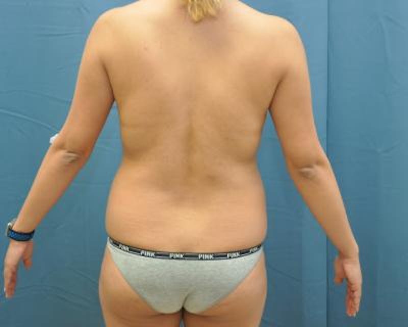 Liposuction Before & After Gallery - Patient 120346688 - Image 3
