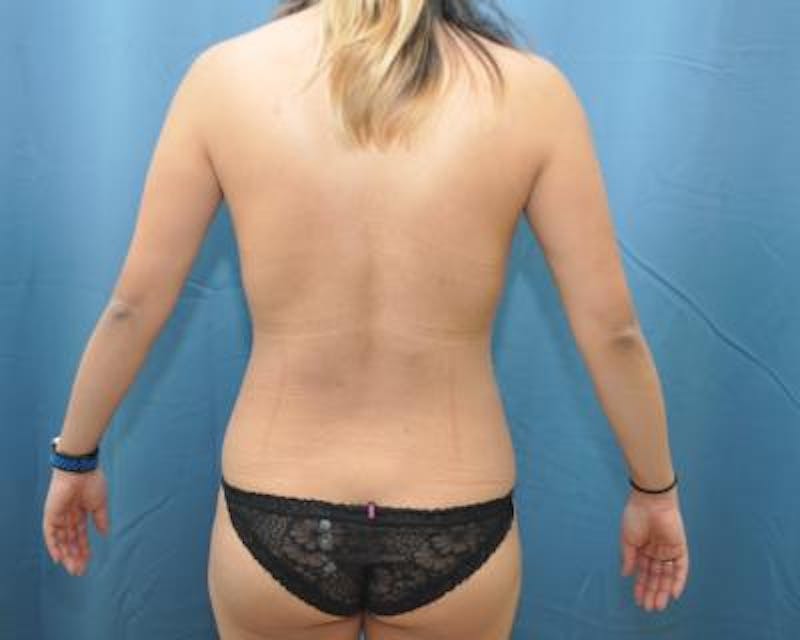 Liposuction Gallery - Patient 120346688 - Image 4