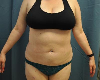 Liposuction Before & After Gallery - Patient 120346702 - Image 2