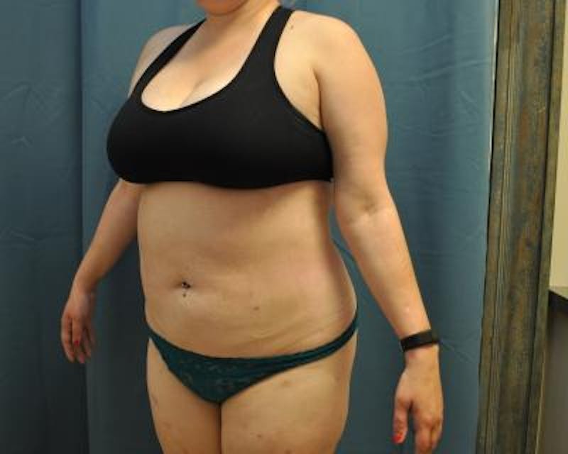 Liposuction Before & After Gallery - Patient 120346702 - Image 4