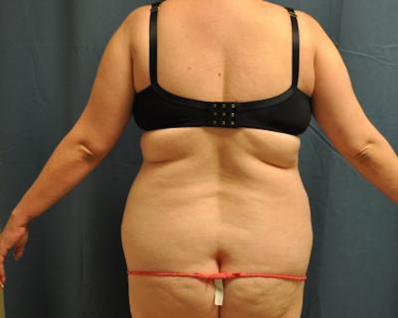 Liposuction Before & After Gallery - Patient 120346702 - Image 5