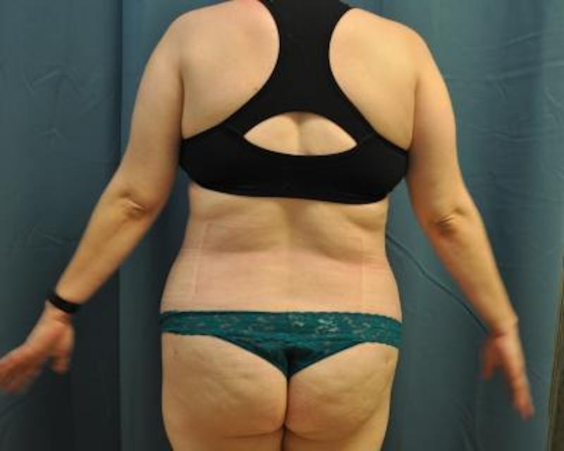Liposuction Before & After Gallery - Patient 120346702 - Image 6