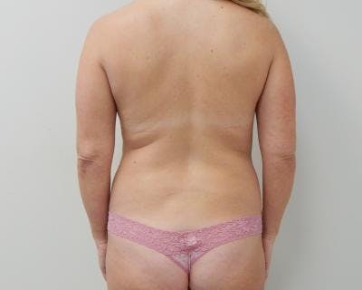 Liposuction Before & After Gallery - Patient 120346703 - Image 1