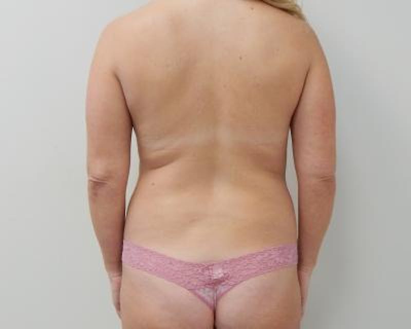 Liposuction Before & After Gallery - Patient 120346703 - Image 1