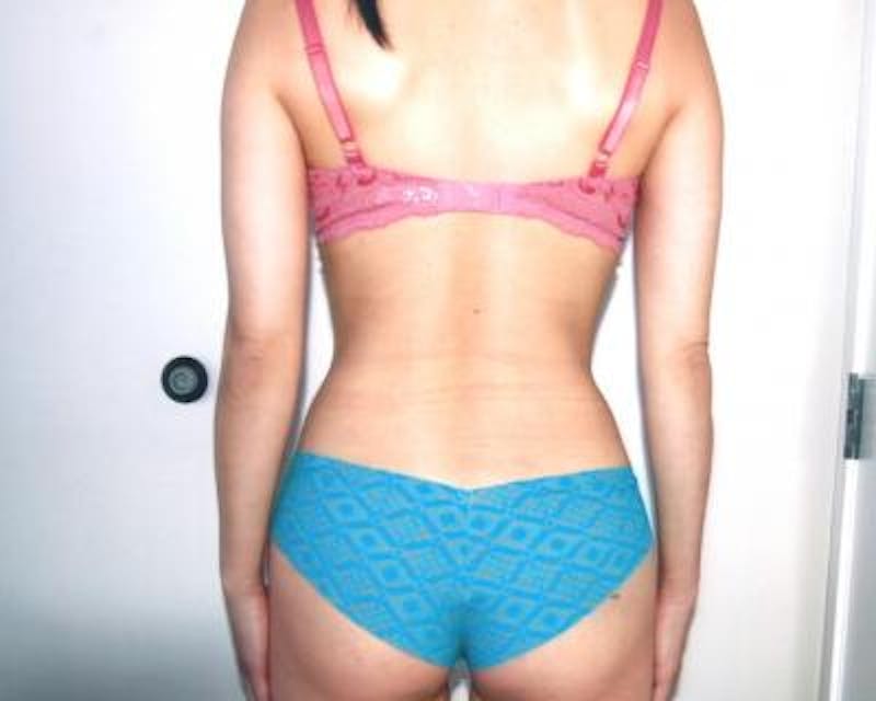 Liposuction Gallery - Patient 120346706 - Image 2