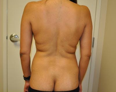Liposuction Before & After Gallery - Patient 120346714 - Image 1