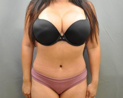 Tummy Tuck Before & After Gallery - Patient 120349549 - Image 2