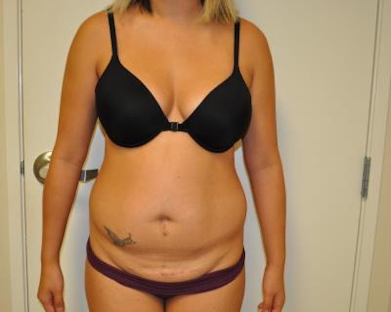 Tummy Tuck Before & After Gallery - Patient 120349564 - Image 1