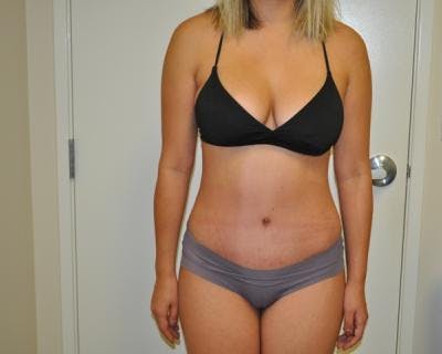 Tummy Tuck Before & After Gallery - Patient 120349564 - Image 2
