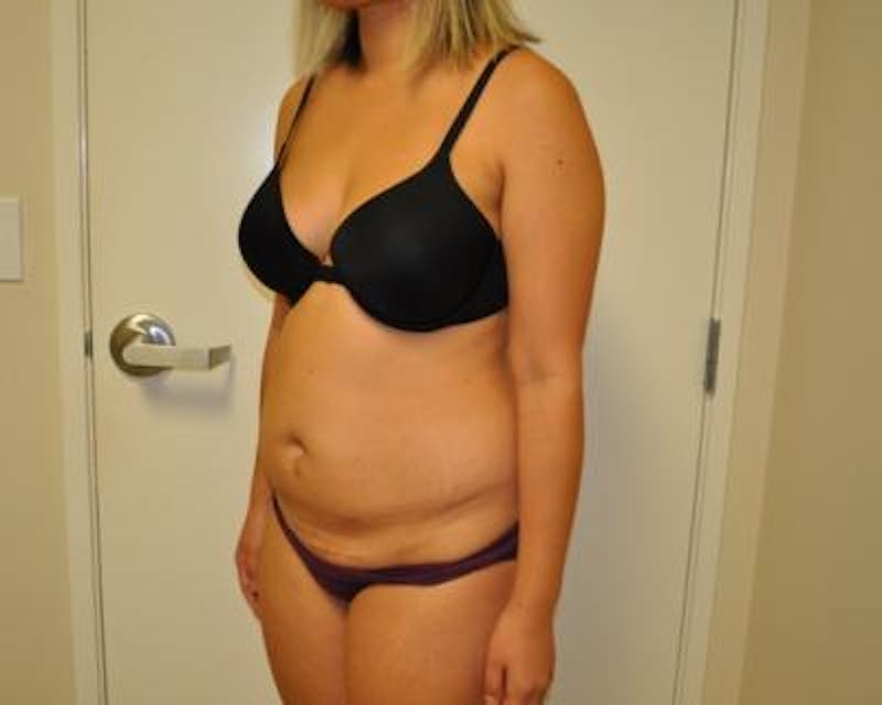Tummy Tuck Before & After Gallery - Patient 120349564 - Image 3