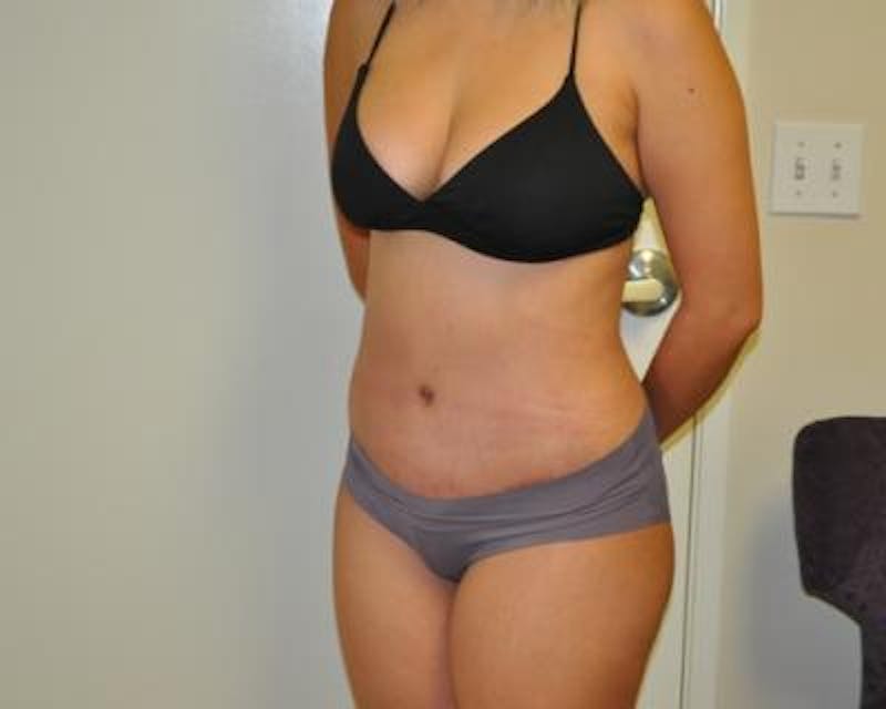 Tummy Tuck Before & After Gallery - Patient 120349564 - Image 4