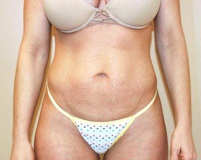 Tummy Tuck Before & After Gallery - Patient 120349572 - Image 1