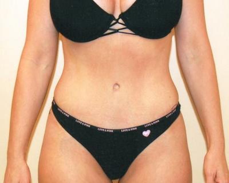 Tummy Tuck Before & After Gallery - Patient 120349572 - Image 2