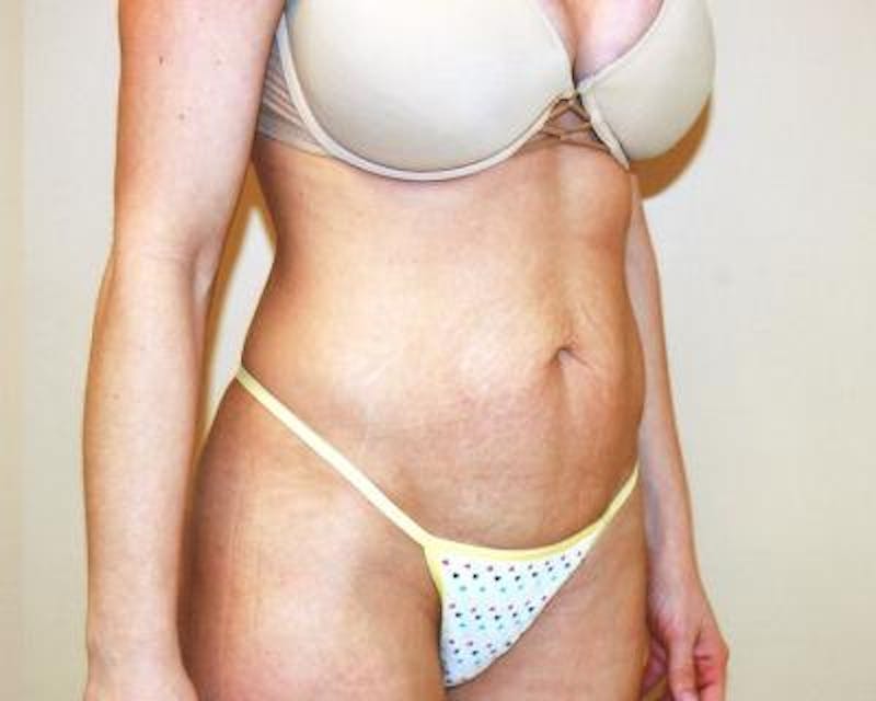 Tummy Tuck Before & After Gallery - Patient 120349572 - Image 3