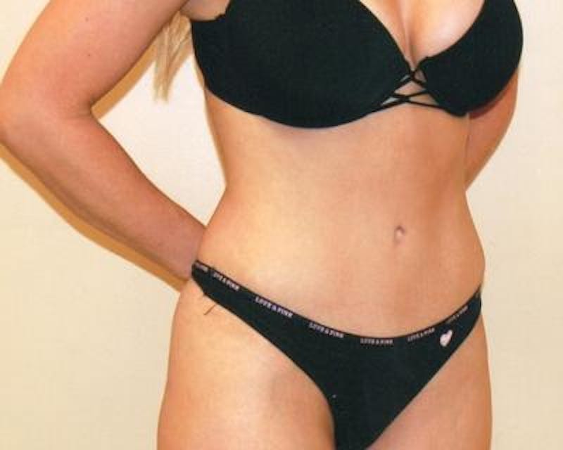 Tummy Tuck Gallery - Patient 120349572 - Image 4