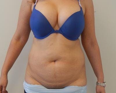 Tummy Tuck Before & After Gallery - Patient 120350051 - Image 1