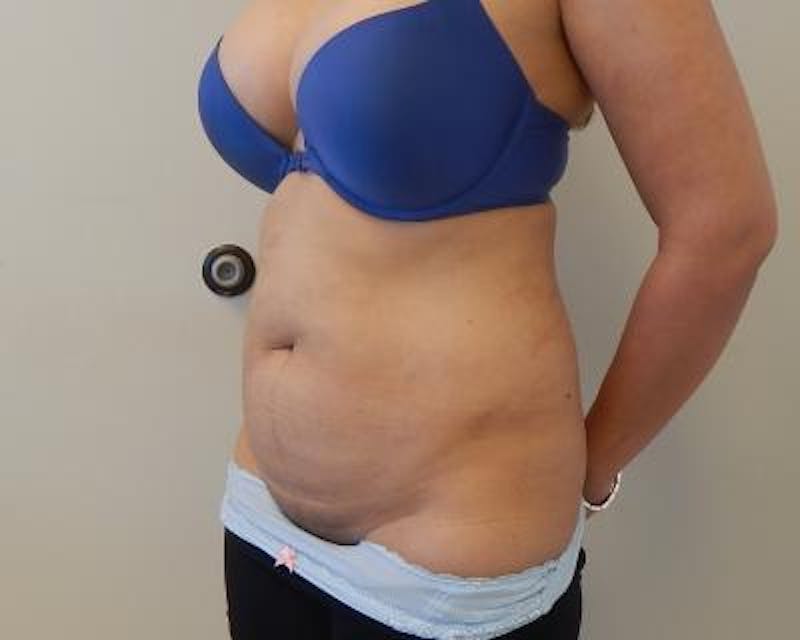 Tummy Tuck Before & After Gallery - Patient 120350051 - Image 3
