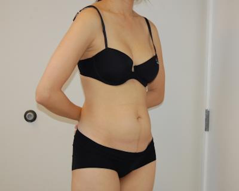 Tummy Tuck Before & After Gallery - Patient 120350058 - Image 3