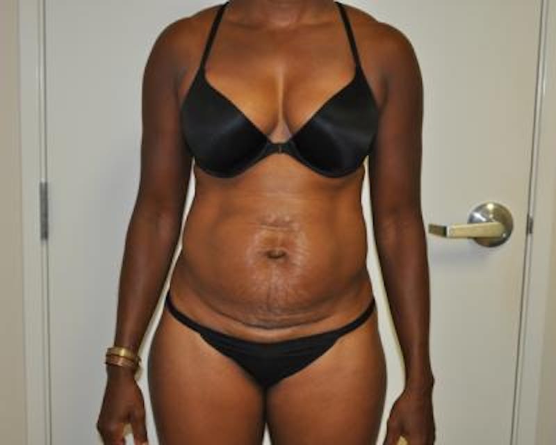 Tummy Tuck Gallery - Patient 120350064 - Image 1