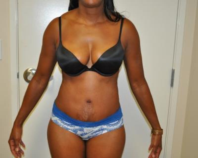 Tummy Tuck Before & After Gallery - Patient 120350064 - Image 2