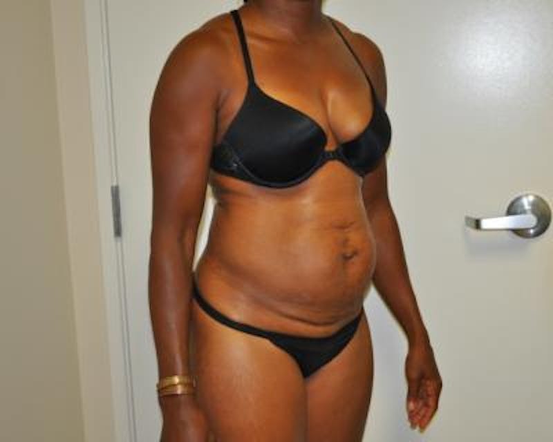 Tummy Tuck Before & After Gallery - Patient 120350064 - Image 3