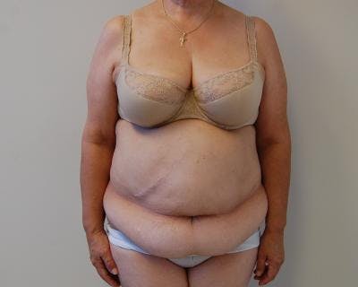 Tummy Tuck Before & After Gallery - Patient 120350085 - Image 1