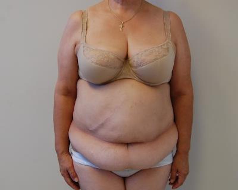 Tummy Tuck Before & After Gallery - Patient 120350085 - Image 1