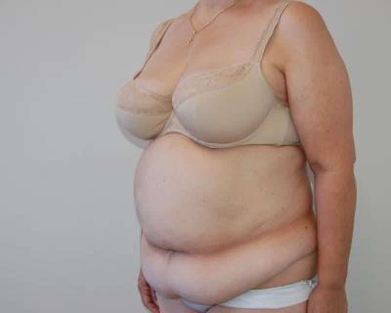 Tummy Tuck Gallery - Patient 120350085 - Image 3
