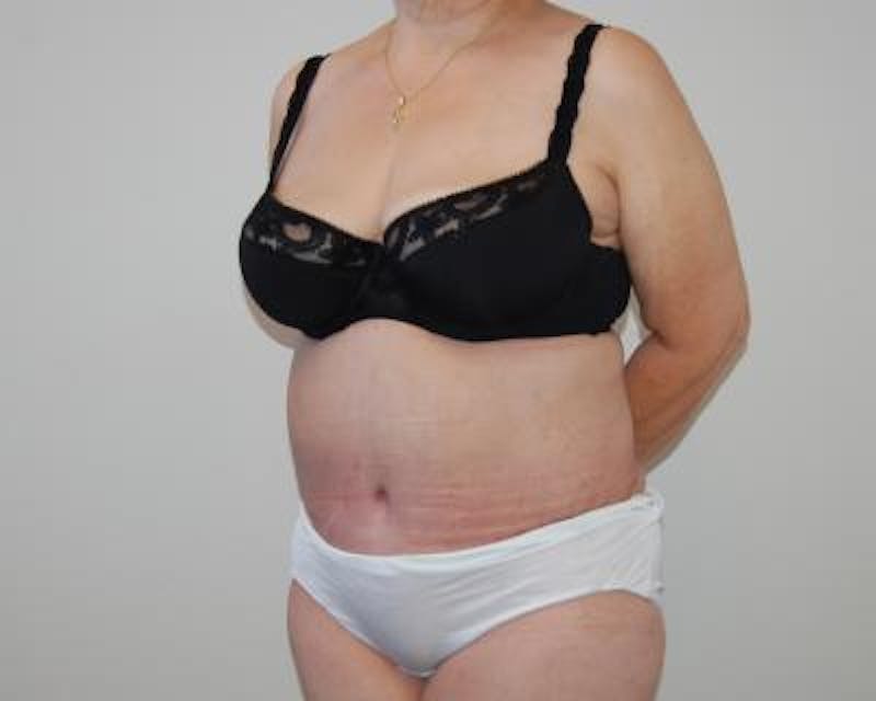 Tummy Tuck Gallery - Patient 120350085 - Image 4