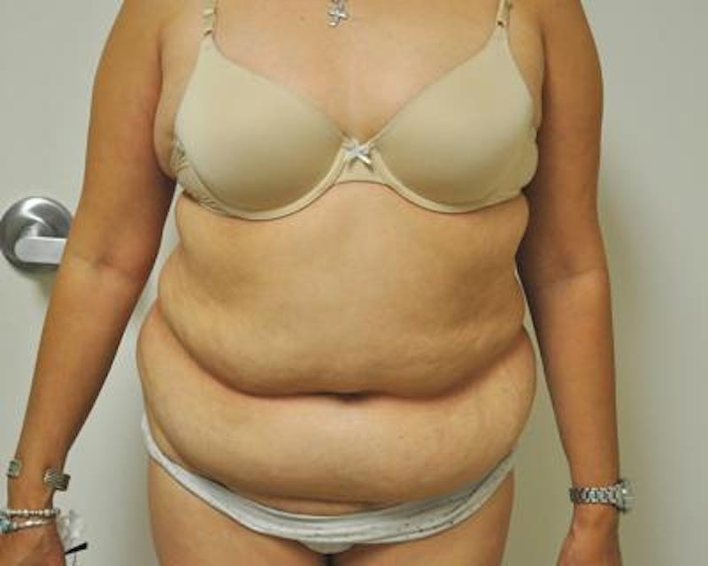 Tummy Tuck Gallery - Patient 120350744 - Image 1