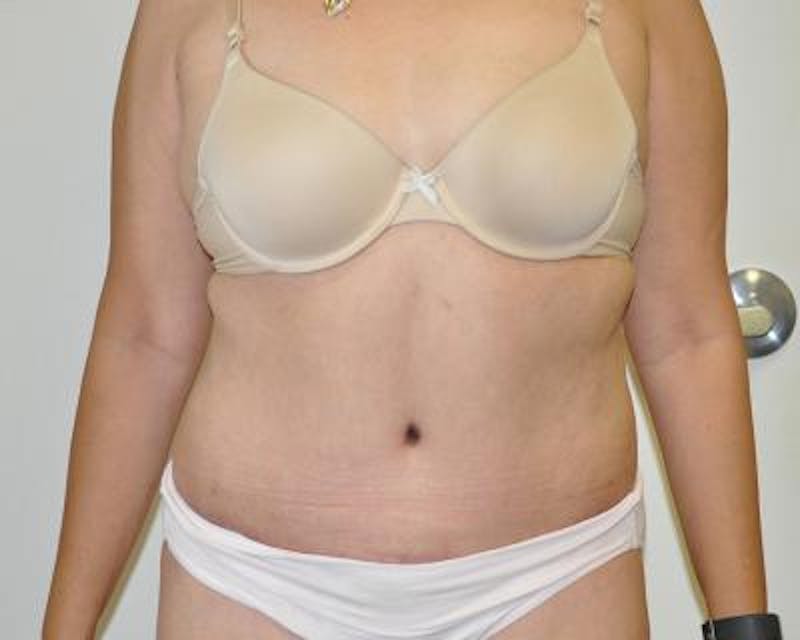 Tummy Tuck Gallery - Patient 120350744 - Image 2