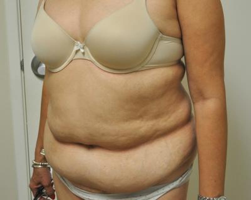 Tummy Tuck Before & After Gallery - Patient 120350744 - Image 3