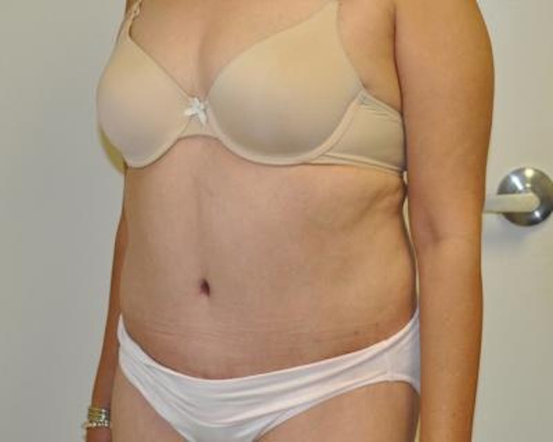 Tummy Tuck Gallery - Patient 120350744 - Image 4