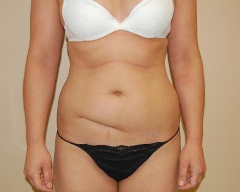 Tummy Tuck Gallery - Patient 120350751 - Image 1