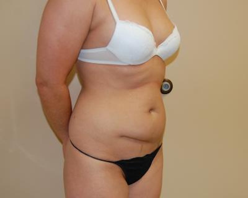 Tummy Tuck Gallery - Patient 120350751 - Image 3
